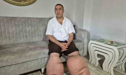 15 yıldır fil hastalığıyla mücadele ediyor