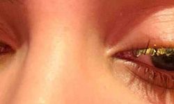 Güzellik merkezinde genç kadının gözüne yapıştırıcı kaçtı