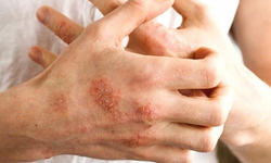 Uzmanından uyarı: "Sıcak ortamlar egzama hastalığını alevlendiriyor"