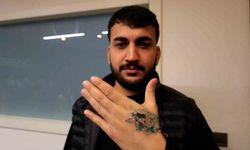 Dövme sildirmek isterken elindeki dokular öldü