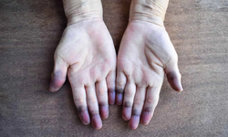 El ve ayaklarda ani renk değişimlerine dikkat edilmeli