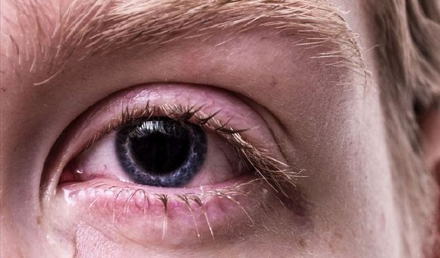 Göz kaşıntısı sebebi kirpik dibi paraziti olabilir