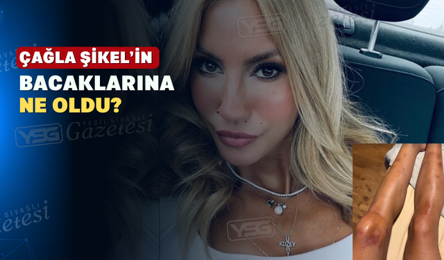Şıkel'in bacağındaki morluklar merak konusu oldu