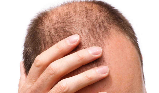 Bu vitaminler eksikse saç dökülme şikayetiniz olabilir