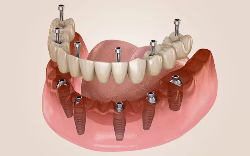 Diş Implantı